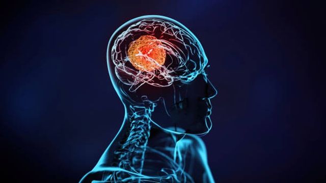 3D illustration of X-ray Imaging of a Human Brain with a Brain Tumor stock photo 