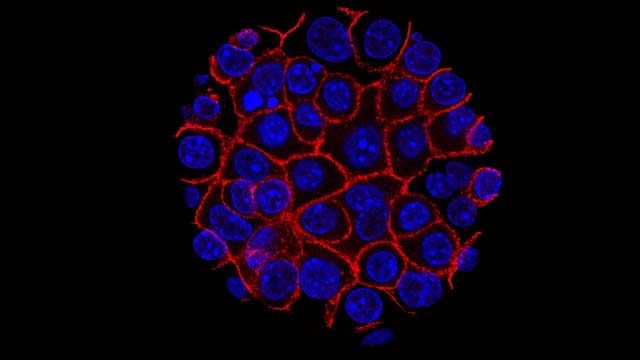 A circle of pancreatic cancer cells, labelled in blue and red. 