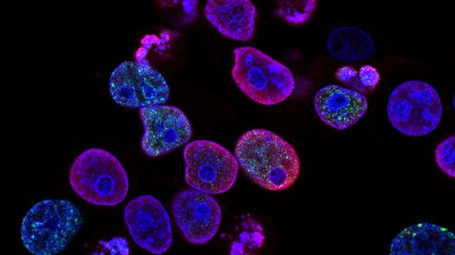 COlorectal cancer cells stained purple, green and blue. 
