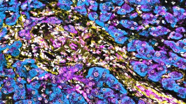 Hepatic stellate cells stained under a microscope. 